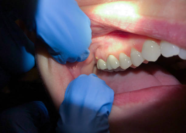 Best Emergency Denture Repair in Billington Heights, NY